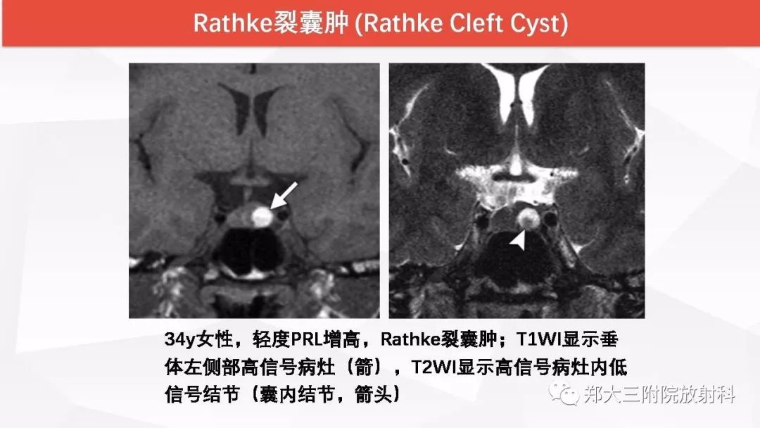 影像PPT - 【PPT】颅内T1WI高信号病变的影像鉴别诊断-8