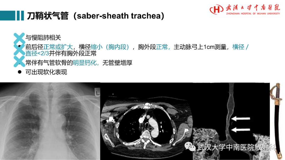 影像PPT - 【病例】复发性多软骨炎1例影像鉴别诊断-16