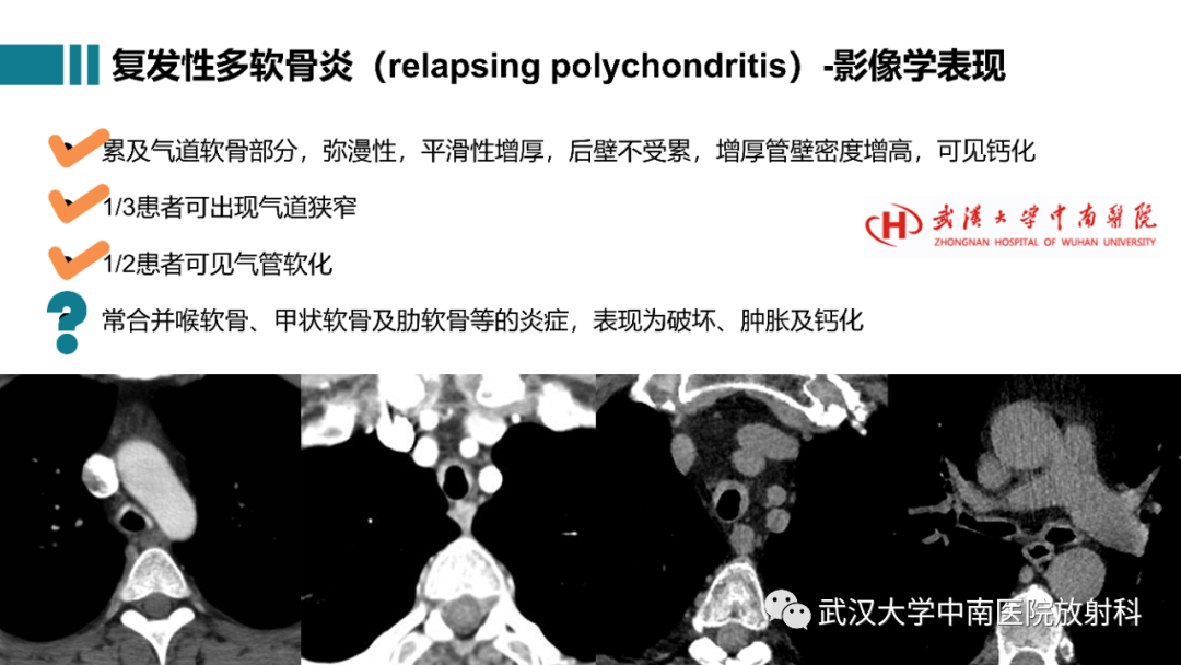 影像PPT - 【病例】复发性多软骨炎1例影像鉴别诊断-23