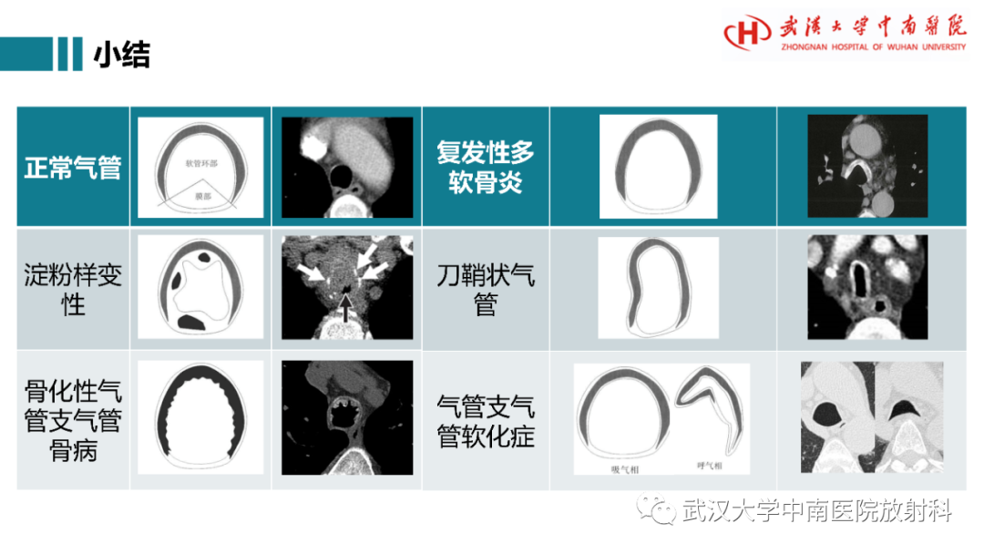 影像PPT - 【病例】复发性多软骨炎1例影像鉴别诊断-24