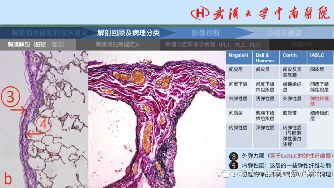 影像PPT - 【PPT】如何影像评估肺癌胸膜侵犯-8