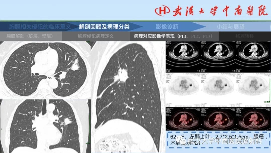 影像PPT - 【PPT】如何影像评估肺癌胸膜侵犯-13