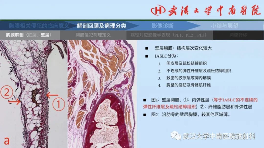 影像PPT - 【PPT】如何影像评估肺癌胸膜侵犯-9