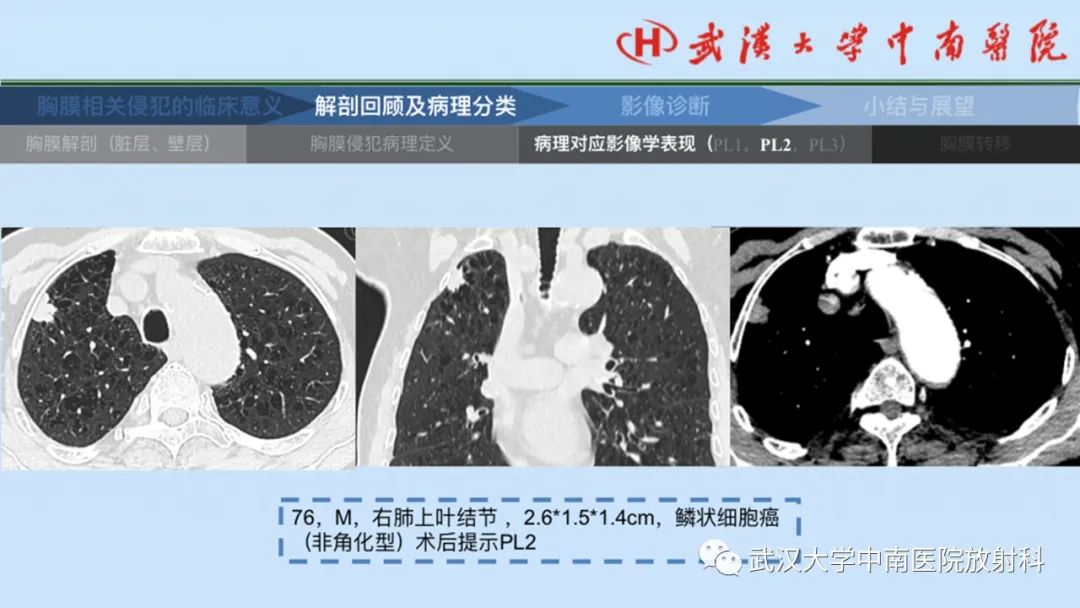 影像PPT - 【PPT】如何影像评估肺癌胸膜侵犯-16