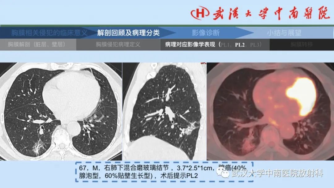 影像PPT - 【PPT】如何影像评估肺癌胸膜侵犯-18