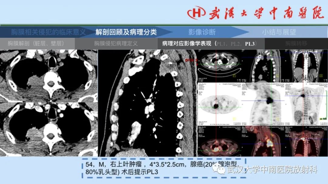 影像PPT - 【PPT】如何影像评估肺癌胸膜侵犯-19