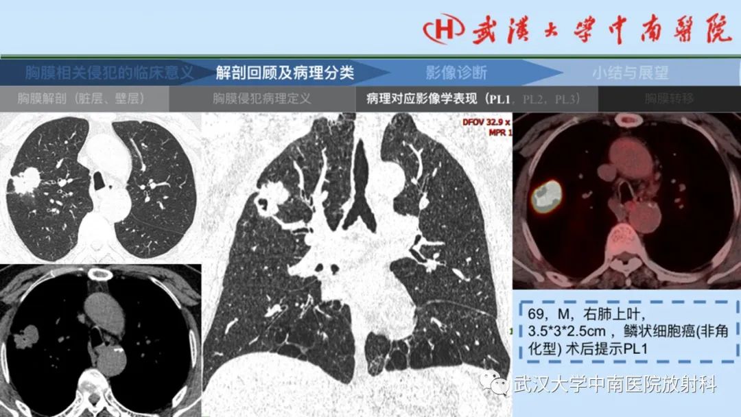 影像PPT - 【PPT】如何影像评估肺癌胸膜侵犯-14