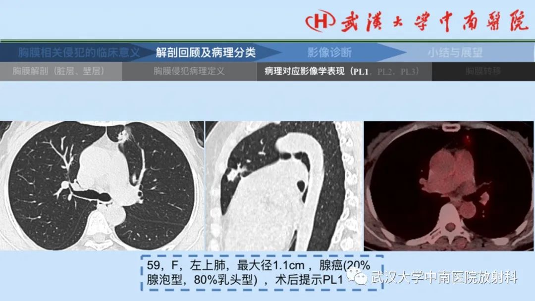 影像PPT - 【PPT】如何影像评估肺癌胸膜侵犯-15