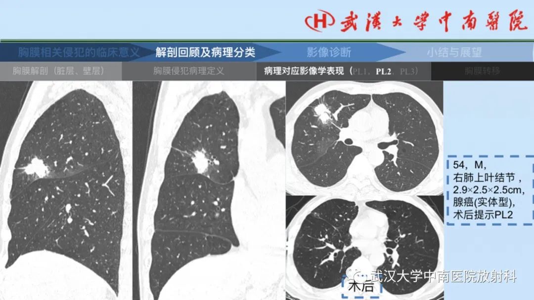 影像PPT - 【PPT】如何影像评估肺癌胸膜侵犯-17