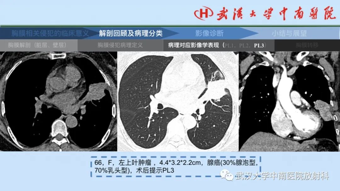 影像PPT - 【PPT】如何影像评估肺癌胸膜侵犯-20