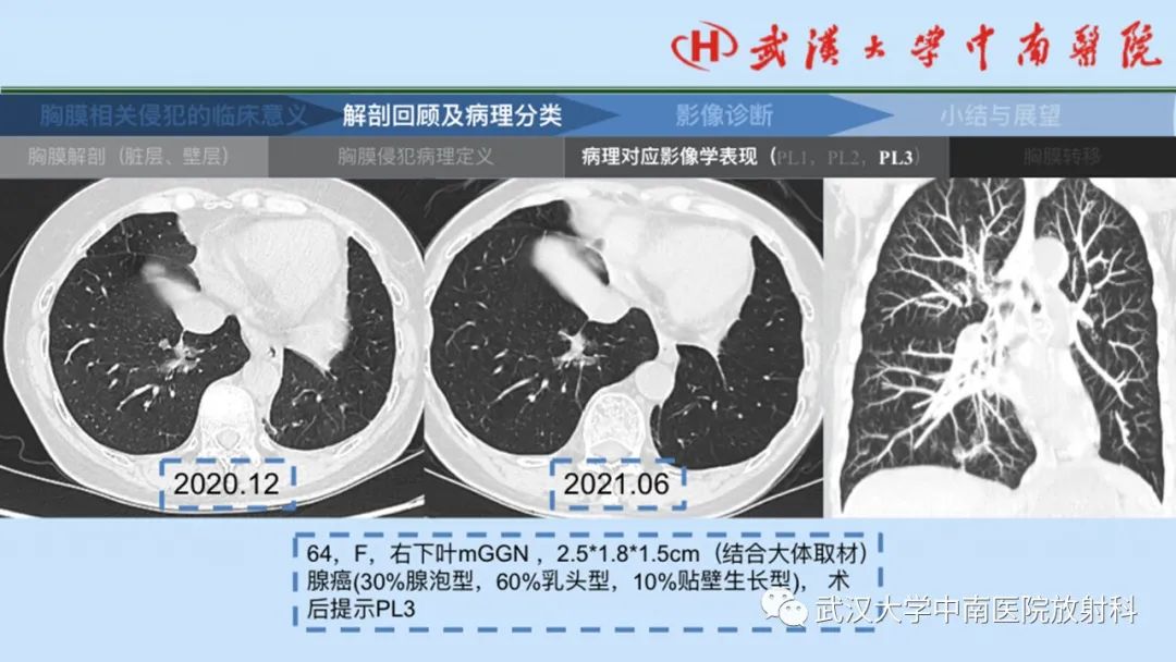影像PPT - 【PPT】如何影像评估肺癌胸膜侵犯-21