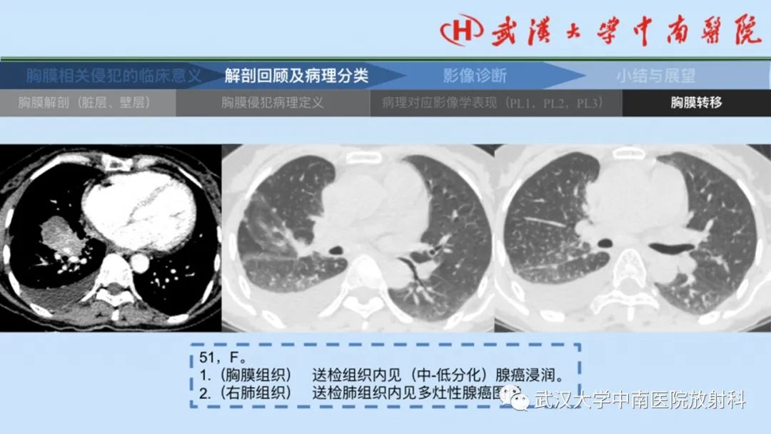 影像PPT - 【PPT】如何影像评估肺癌胸膜侵犯-24