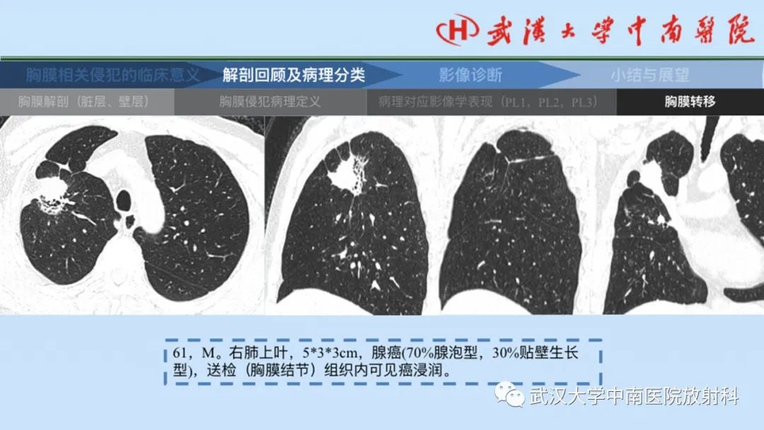 影像PPT - 【PPT】如何影像评估肺癌胸膜侵犯-25