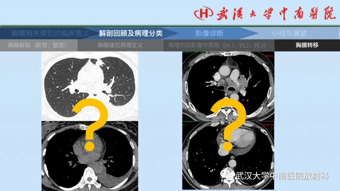 影像PPT - 【PPT】如何影像评估肺癌胸膜侵犯-26