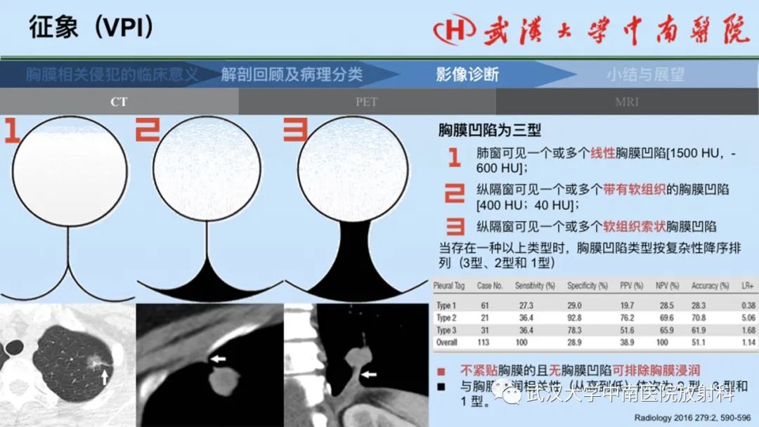影像PPT - 【PPT】如何影像评估肺癌胸膜侵犯-28