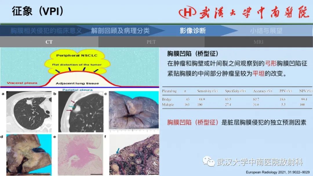影像PPT - 【PPT】如何影像评估肺癌胸膜侵犯-29