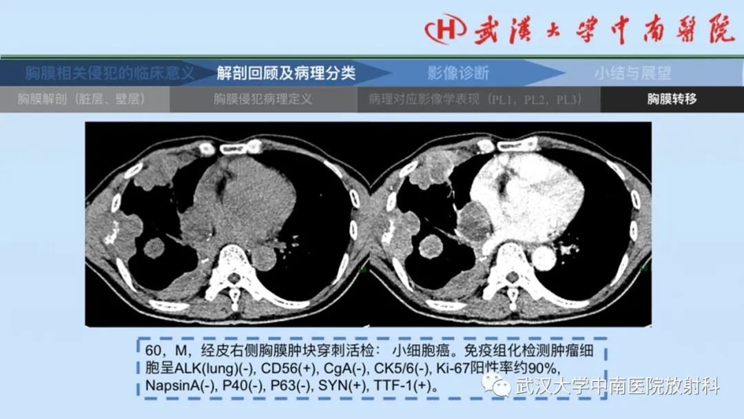 影像PPT - 【PPT】如何影像评估肺癌胸膜侵犯-23