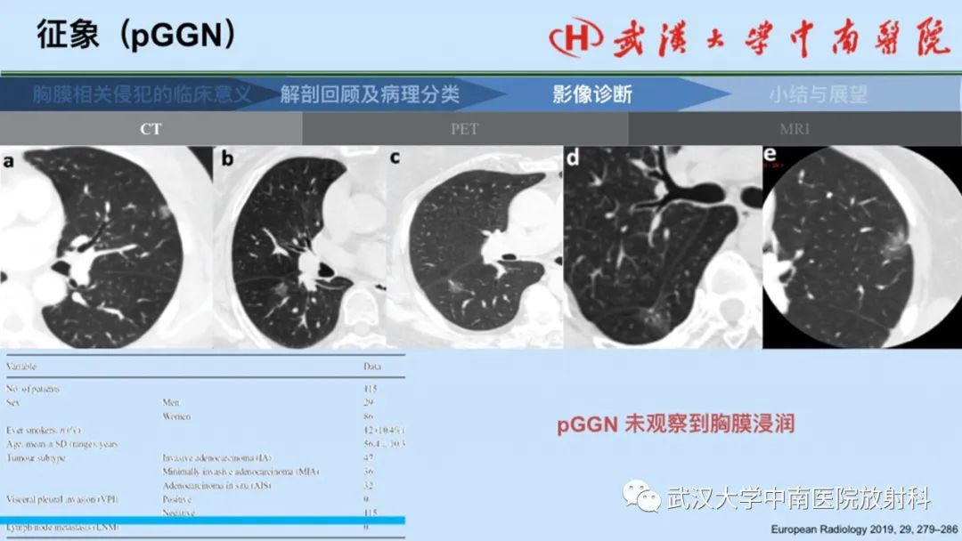 影像PPT - 【PPT】如何影像评估肺癌胸膜侵犯-33