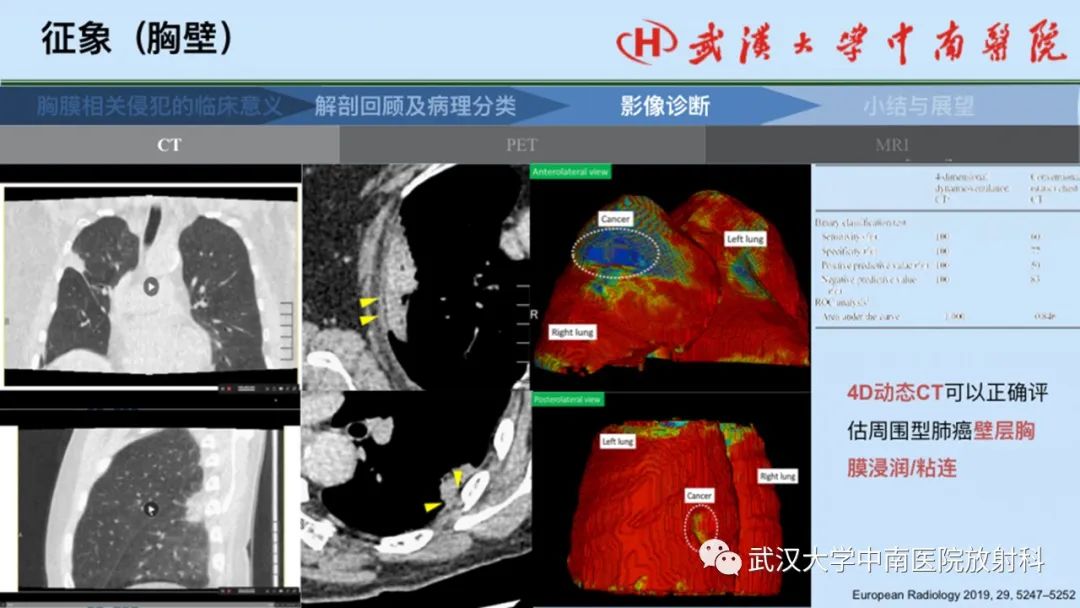 影像PPT - 【PPT】如何影像评估肺癌胸膜侵犯-32