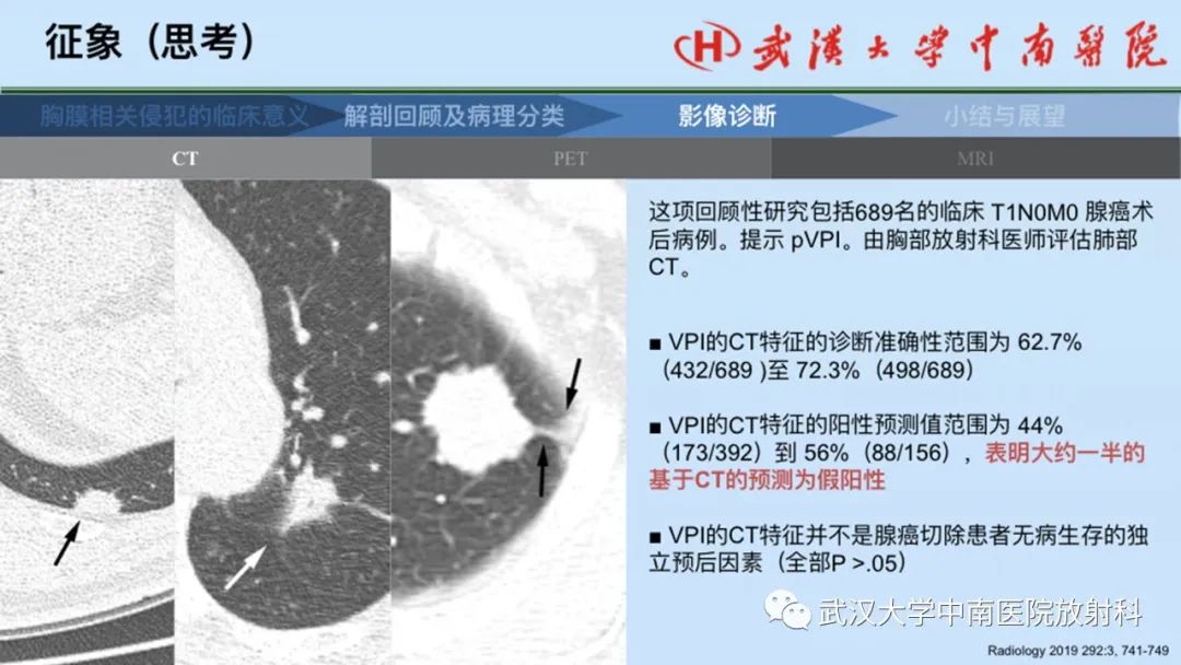 影像PPT - 【PPT】如何影像评估肺癌胸膜侵犯-37