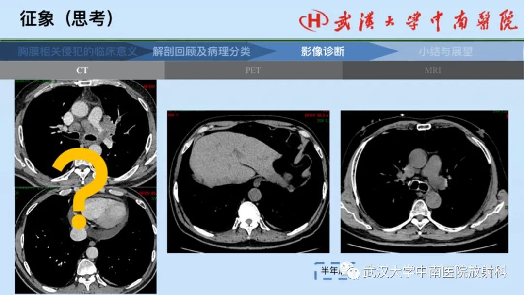 影像PPT - 【PPT】如何影像评估肺癌胸膜侵犯-38