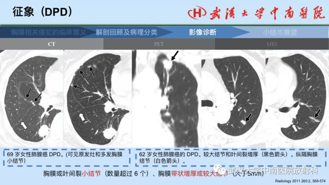 影像PPT - 【PPT】如何影像评估肺癌胸膜侵犯-35
