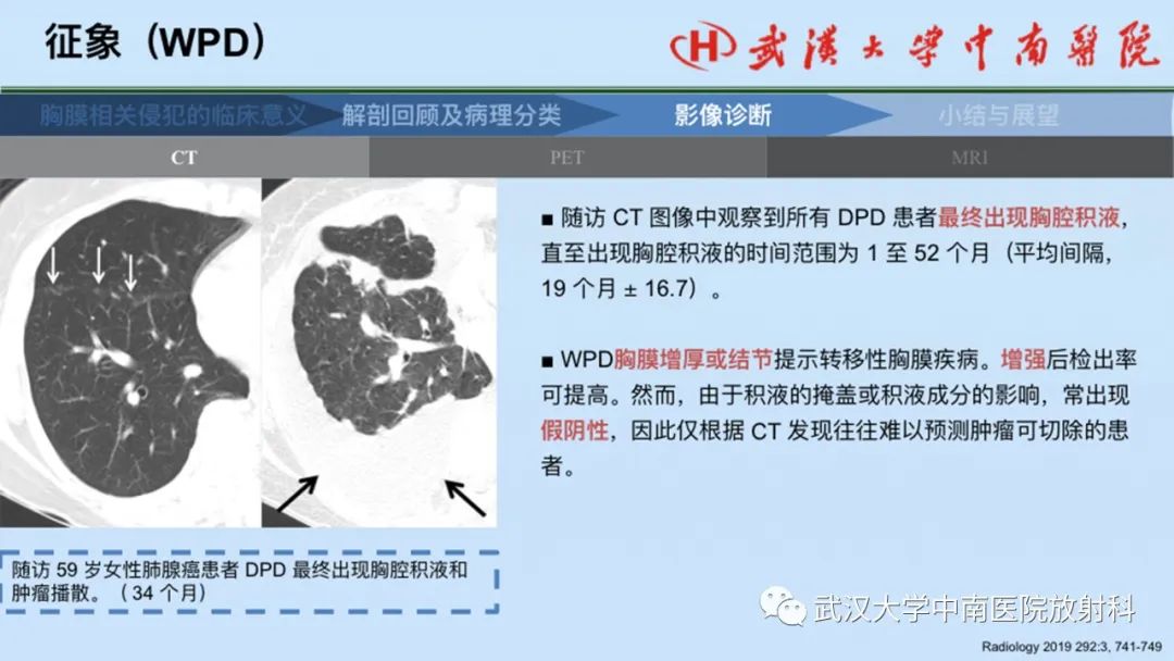 影像PPT - 【PPT】如何影像评估肺癌胸膜侵犯-36