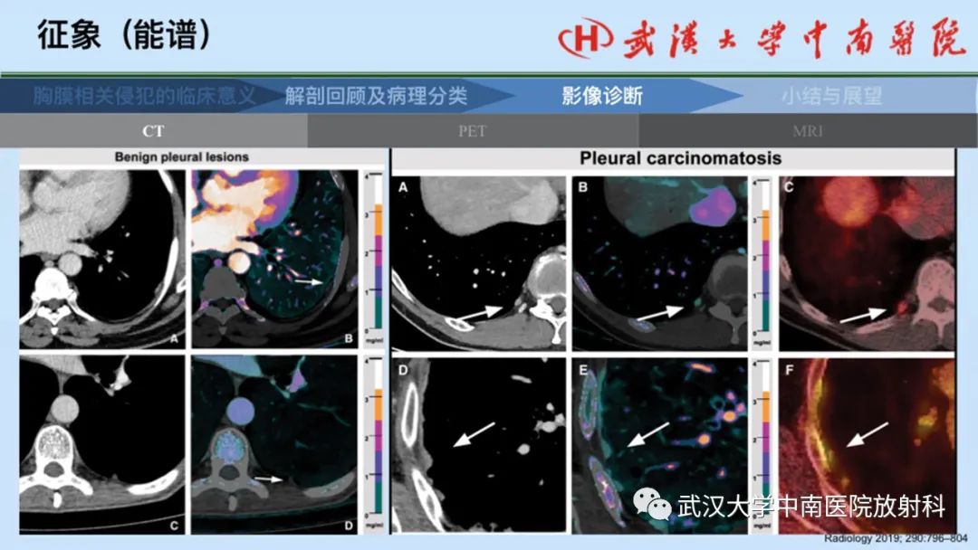 影像PPT - 【PPT】如何影像评估肺癌胸膜侵犯-43
