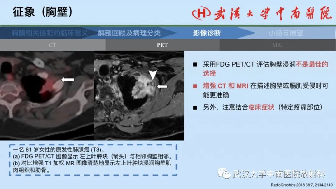 影像PPT - 【PPT】如何影像评估肺癌胸膜侵犯-46