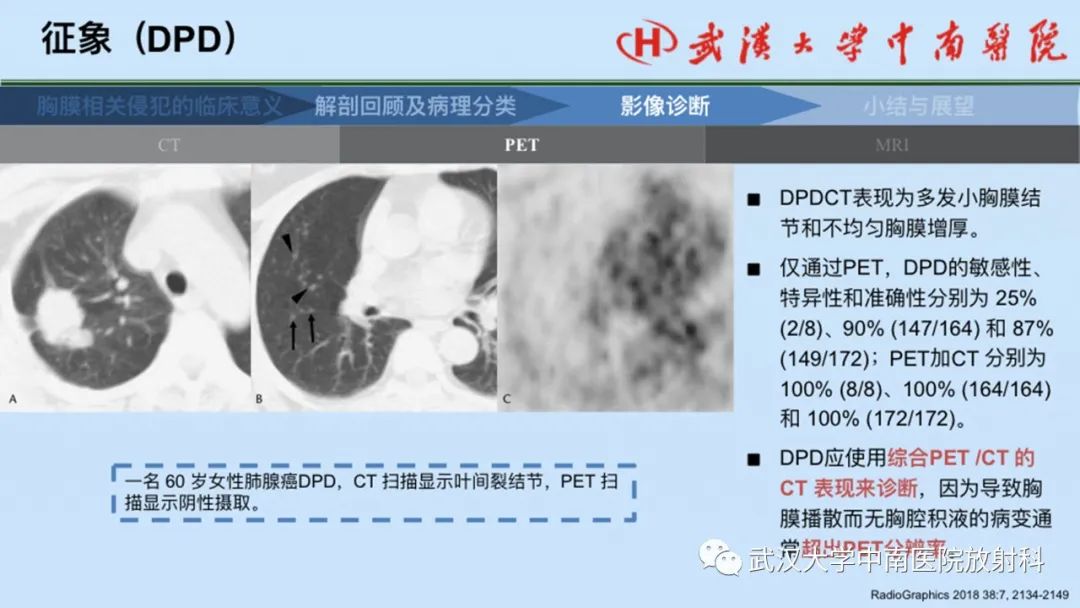 影像PPT - 【PPT】如何影像评估肺癌胸膜侵犯-47