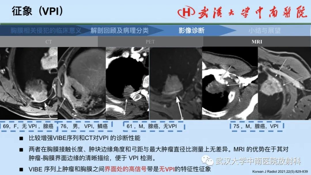 影像PPT - 【PPT】如何影像评估肺癌胸膜侵犯-51