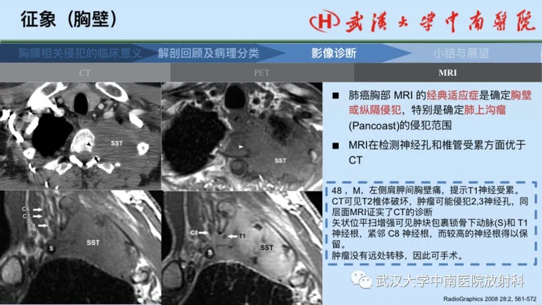 影像PPT - 【PPT】如何影像评估肺癌胸膜侵犯-53