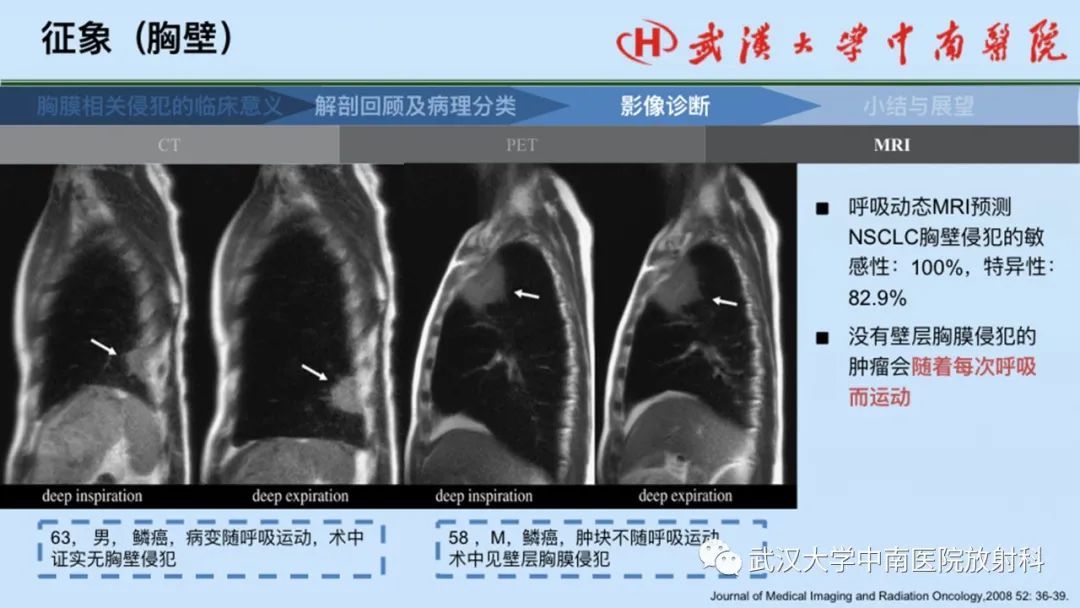 影像PPT - 【PPT】如何影像评估肺癌胸膜侵犯-52