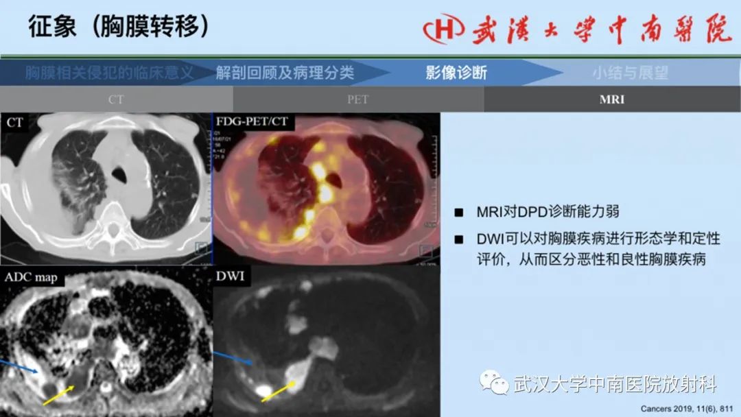 影像PPT - 【PPT】如何影像评估肺癌胸膜侵犯-54