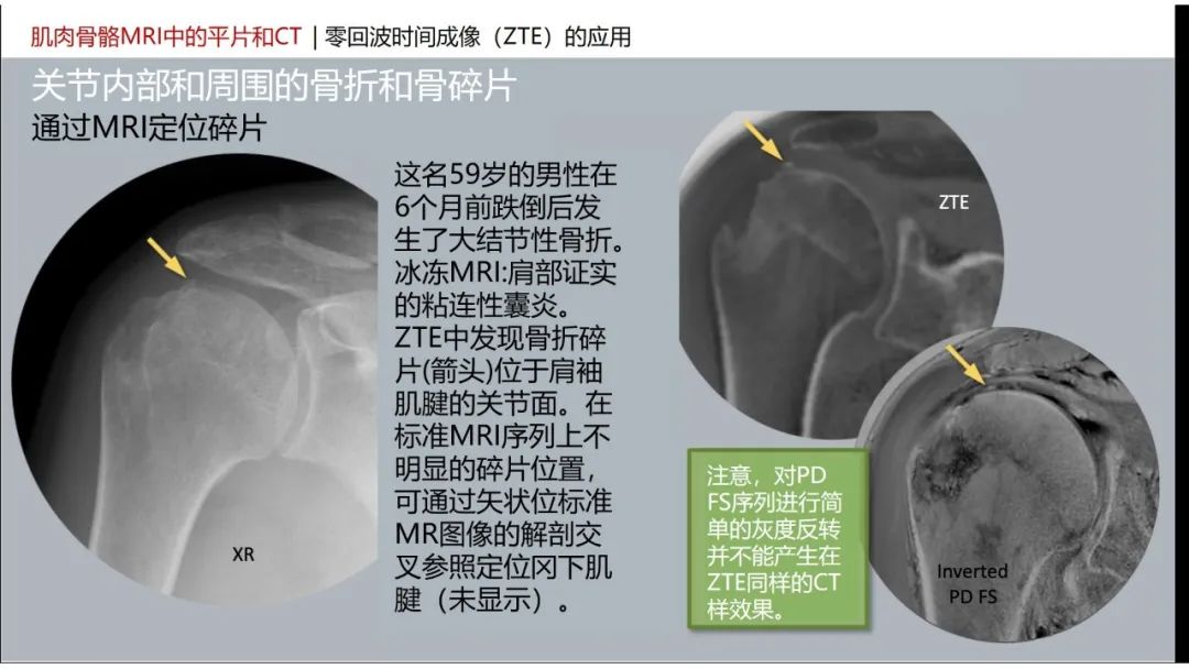 影像PPT - 【PPT】肌肉骨骼MRI中的平片和CT——零回波时间（ZTE）成像的挑战、优化和应用-3