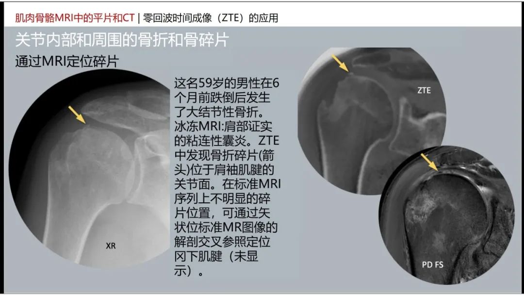 影像PPT - 【PPT】肌肉骨骼MRI中的平片和CT——零回波时间（ZTE）成像的挑战、优化和应用-1