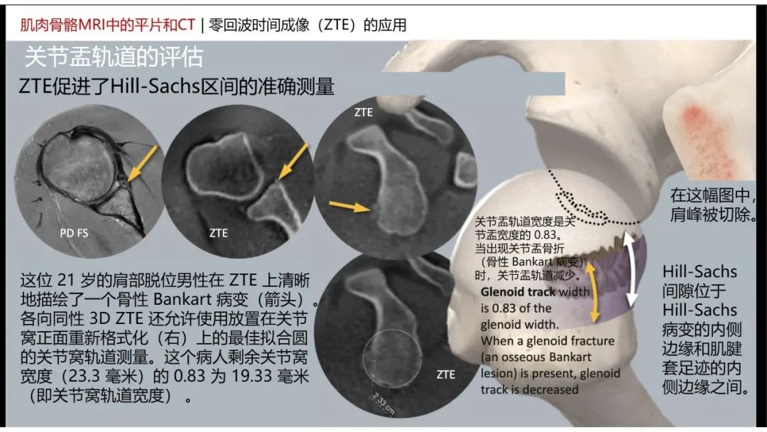 影像PPT - 【PPT】肌肉骨骼MRI中的平片和CT——零回波时间（ZTE）成像的挑战、优化和应用-7
