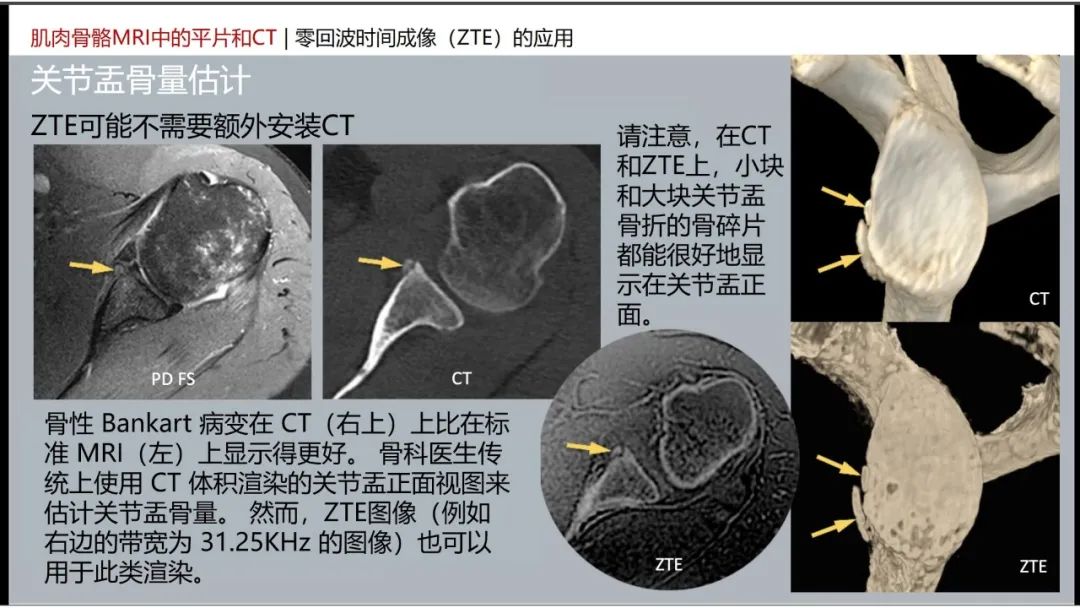 影像PPT - 【PPT】肌肉骨骼MRI中的平片和CT——零回波时间（ZTE）成像的挑战、优化和应用-5