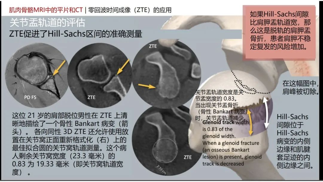 影像PPT - 【PPT】肌肉骨骼MRI中的平片和CT——零回波时间（ZTE）成像的挑战、优化和应用-9
