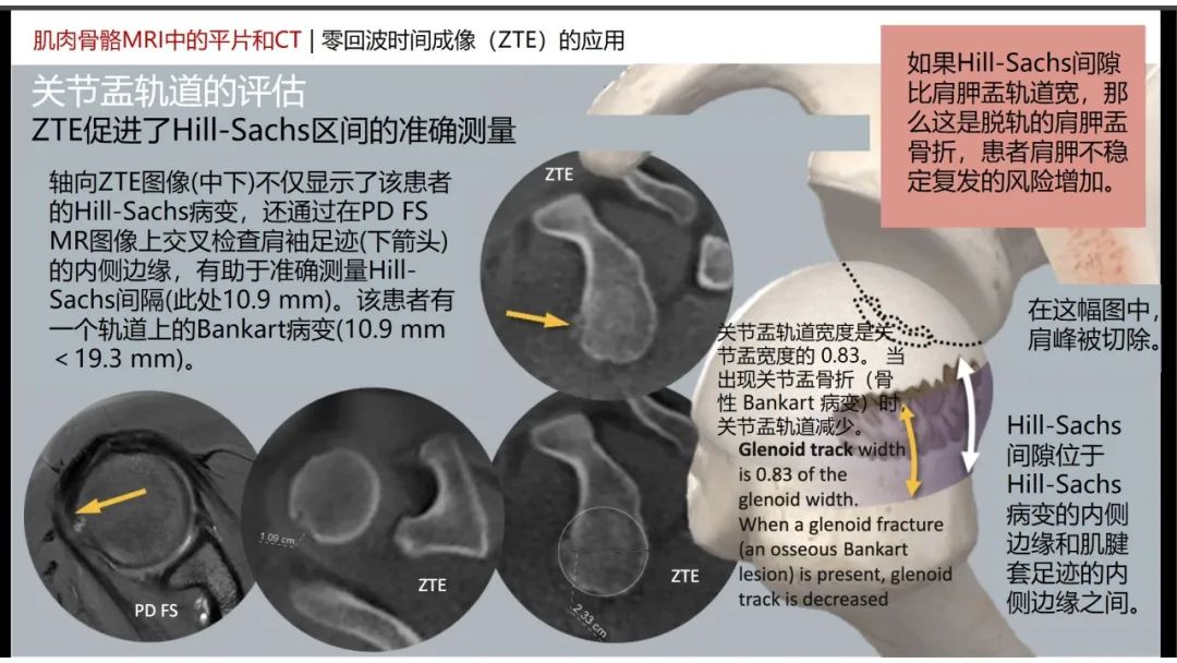 影像PPT - 【PPT】肌肉骨骼MRI中的平片和CT——零回波时间（ZTE）成像的挑战、优化和应用-11