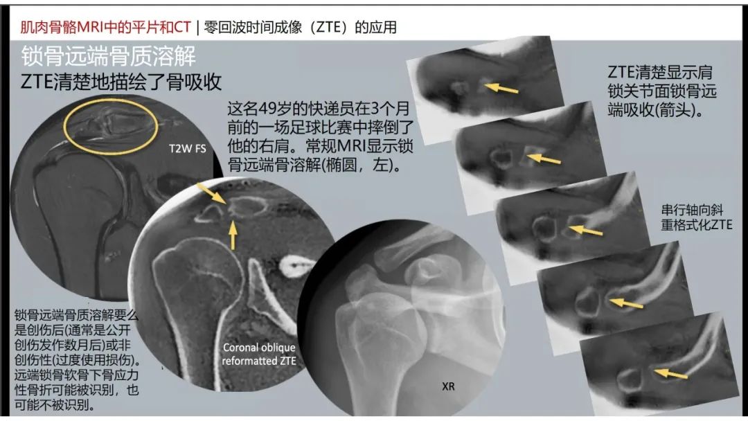 影像PPT - 【PPT】肌肉骨骼MRI中的平片和CT——零回波时间（ZTE）成像的挑战、优化和应用-13