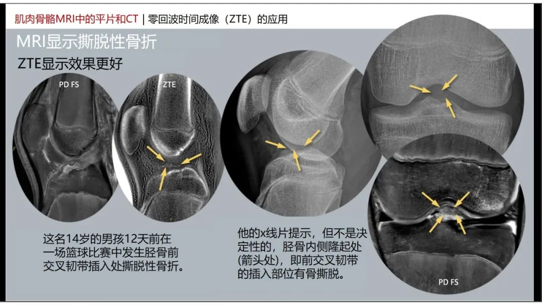 影像PPT - 【PPT】肌肉骨骼MRI中的平片和CT——零回波时间（ZTE）成像的挑战、优化和应用-15