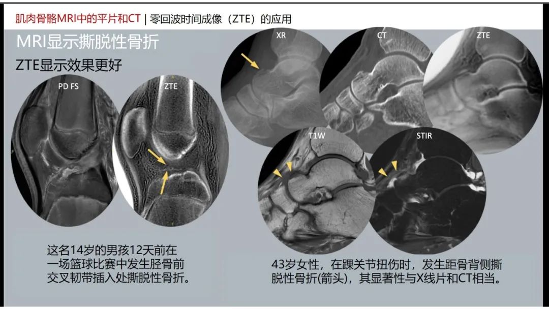 影像PPT - 【PPT】肌肉骨骼MRI中的平片和CT——零回波时间（ZTE）成像的挑战、优化和应用-17