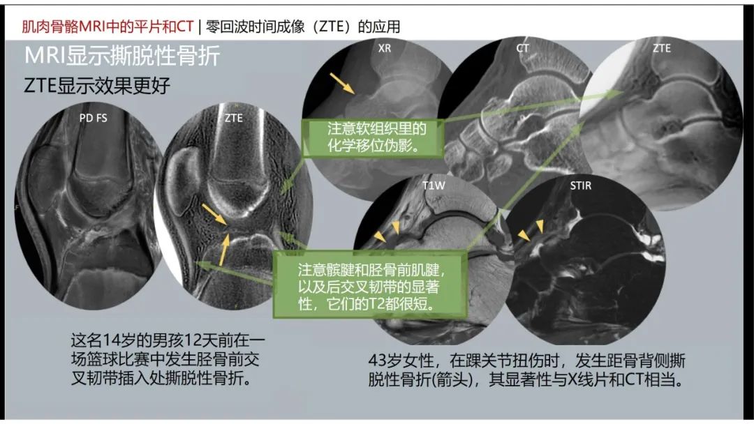 影像PPT - 【PPT】肌肉骨骼MRI中的平片和CT——零回波时间（ZTE）成像的挑战、优化和应用-19