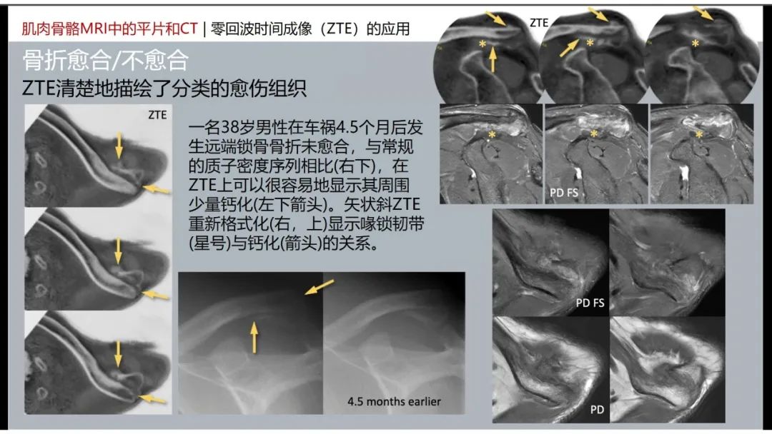影像PPT - 【PPT】肌肉骨骼MRI中的平片和CT——零回波时间（ZTE）成像的挑战、优化和应用-25