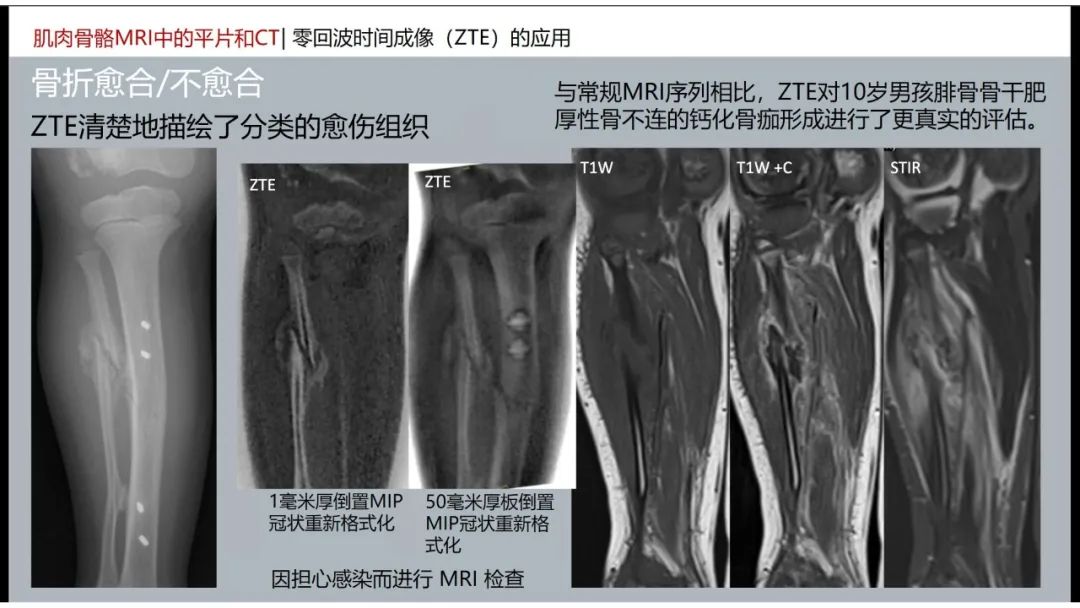 影像PPT - 【PPT】肌肉骨骼MRI中的平片和CT——零回波时间（ZTE）成像的挑战、优化和应用-27