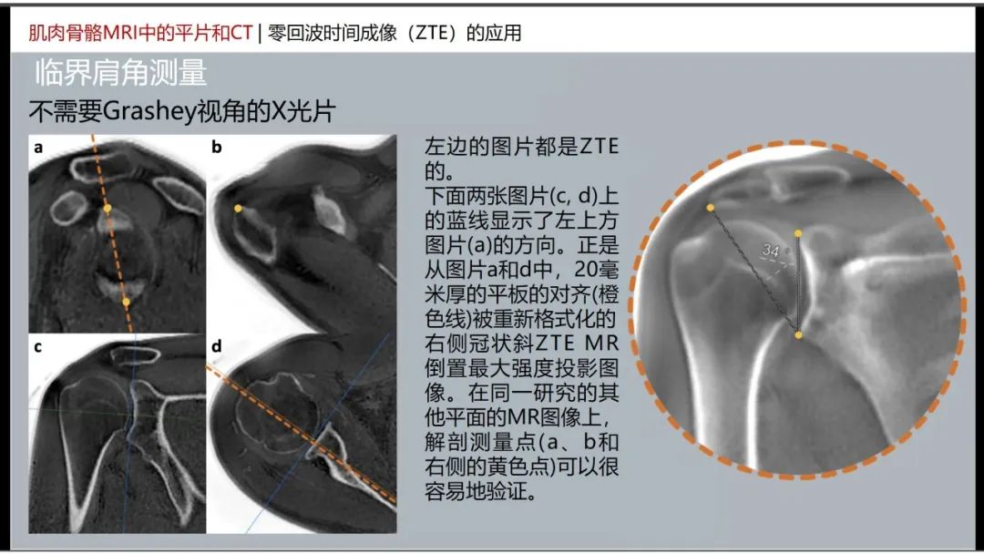 影像PPT - 【PPT】肌肉骨骼MRI中的平片和CT——零回波时间（ZTE）成像的挑战、优化和应用-31