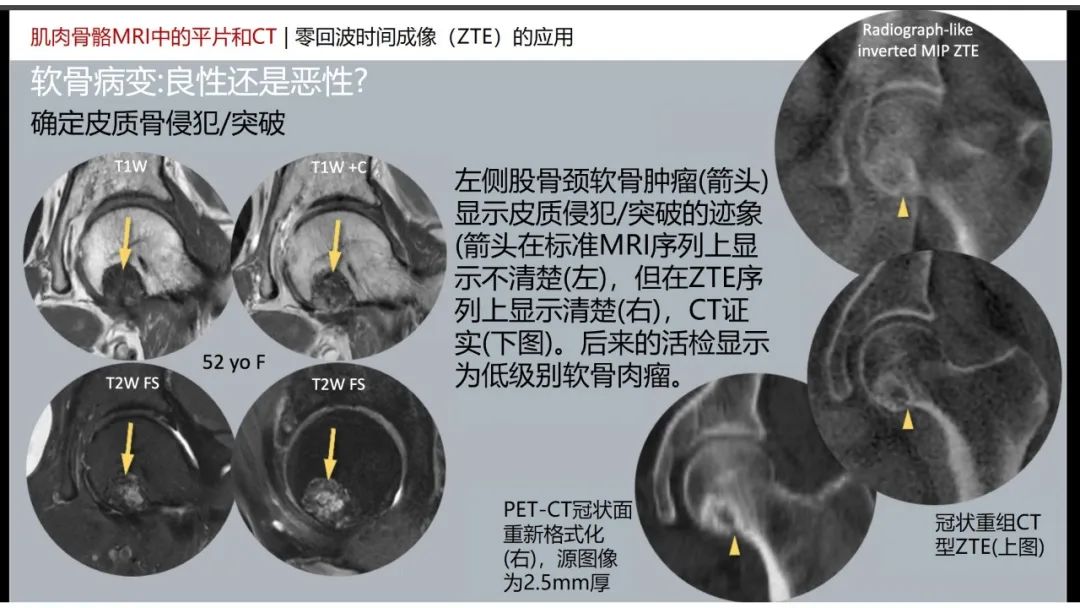 影像PPT - 【PPT】肌肉骨骼MRI中的平片和CT——零回波时间（ZTE）成像的挑战、优化和应用-35