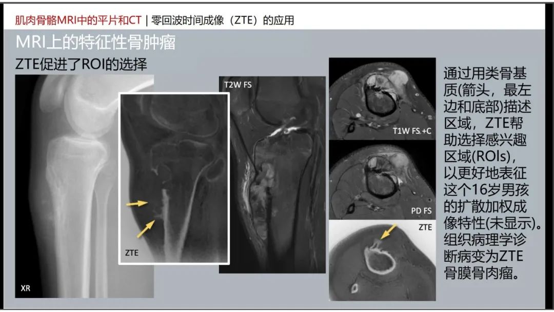 影像PPT - 【PPT】肌肉骨骼MRI中的平片和CT——零回波时间（ZTE）成像的挑战、优化和应用-37