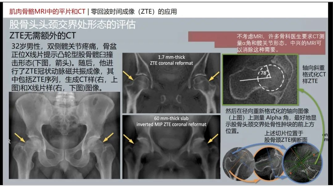 影像PPT - 【PPT】肌肉骨骼MRI中的平片和CT——零回波时间（ZTE）成像的挑战、优化和应用-33